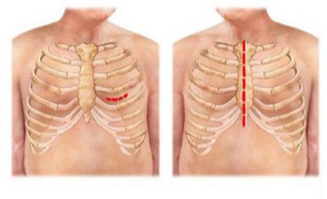 İman Tahtasına Neşter Vurmadan Bypass Ameliyatı