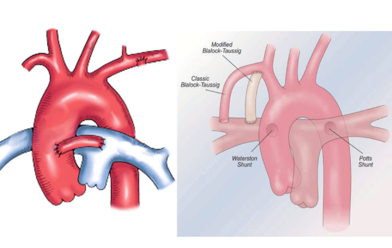 Siyanotik Seyirli Doğumsal Kalp Anomalileri