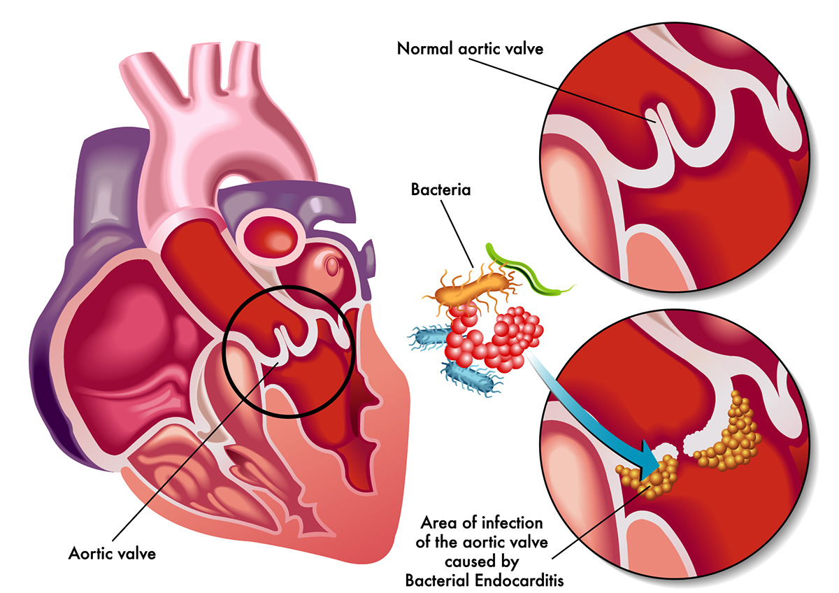 Enfeksiyona Bağlı Edinsel Kalp Hastalıkları